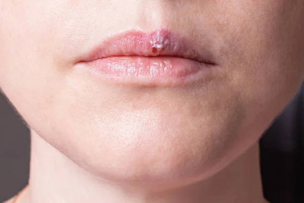 bir kadının yüzü, herpes dilinde, güzellik kavramı parçası