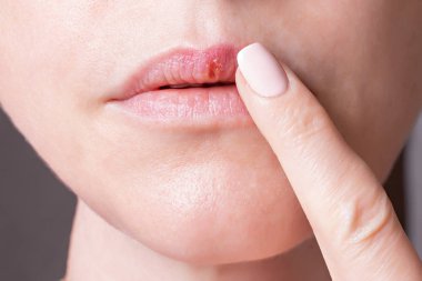 bir kadının yüzü, herpes dilinde, güzellik kavramı parçası