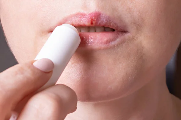 Herpes op de lippen van de jonge vrouw. Vrouw smeert de labiale herpes zalf — Stockfoto