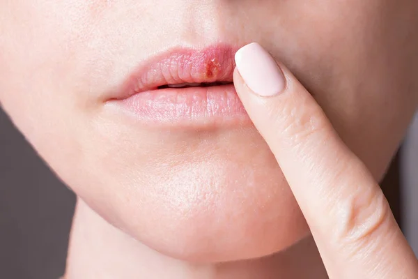 Parte di un volto femminile, herpes sulle labbra, concetto di bellezza — Foto Stock