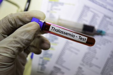 Talasemi - Kan örneği ile test edin. Ofis masasında izole üst görünüm. Sağlık / Tıp kavramı