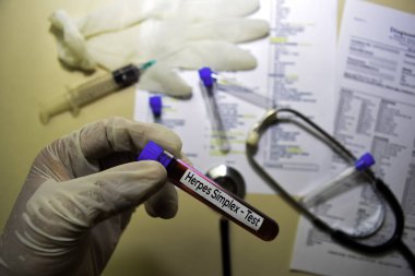 Herpes Simplex - Kan örneği ile test edin. Ofis masasında izole üst görünüm. Sağlık / Tıp kavramı