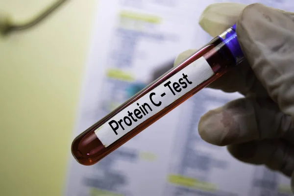 Proteína C - Prueba con muestra de sangre. Vista superior aislada en el escritorio de la oficina. Salud / Concepto médico — Foto de Stock