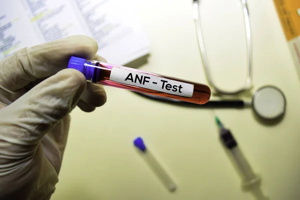 ANF - Prueba con muestra de sangre. Vista superior aislada en el escritorio de la oficina. Salud / Concepto médico — Foto de Stock