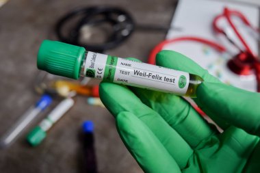 Weil-Felix test aşısı ilacı yeşil eldivenli ellerde. Tıbbi konsept