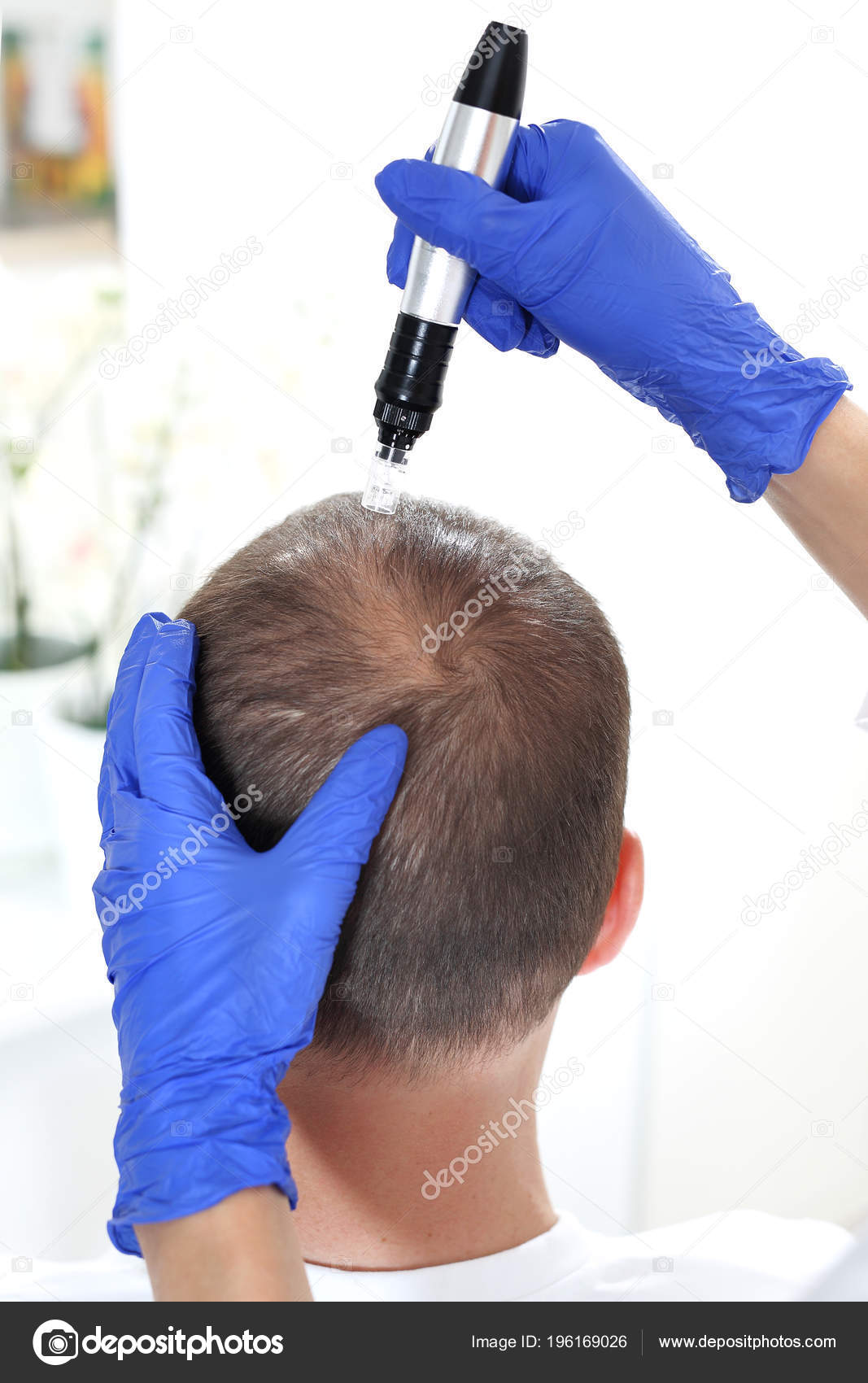 Needle Mesotherapy Scalp Head Man Thinning Hair Needle Mesotherapy Stock  Photo by ©robertprzybysz 196169032