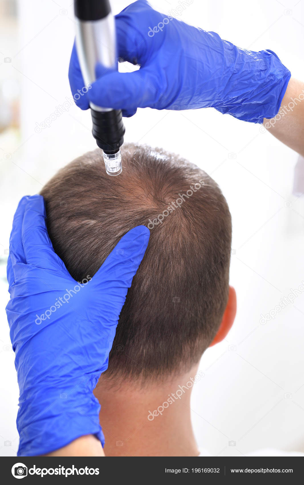 Needle Mesotherapy Scalp Head Man Thinning Hair Needle Mesotherapy