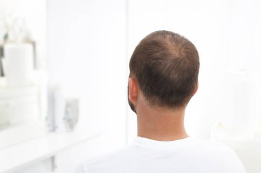 Saç dökülmesi. Saç inceltme bir insan kafası