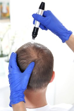 Microneedle mesotherapy of the scalp. The head of a man with thinning hair during needle mesotherapy clipart