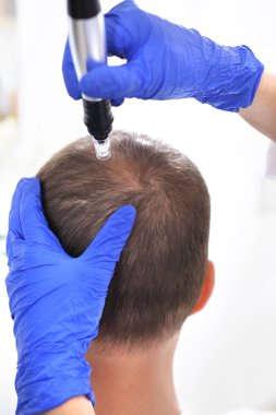 Needle mesotherapy of the scalp. The head of a man with thinning hair during needle mesotherapy clipart