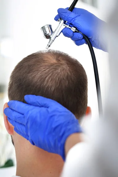 Terapi Oksigen Dari Kulit Kepala Kepala Seorang Pria Dengan Rambut — Stok Foto