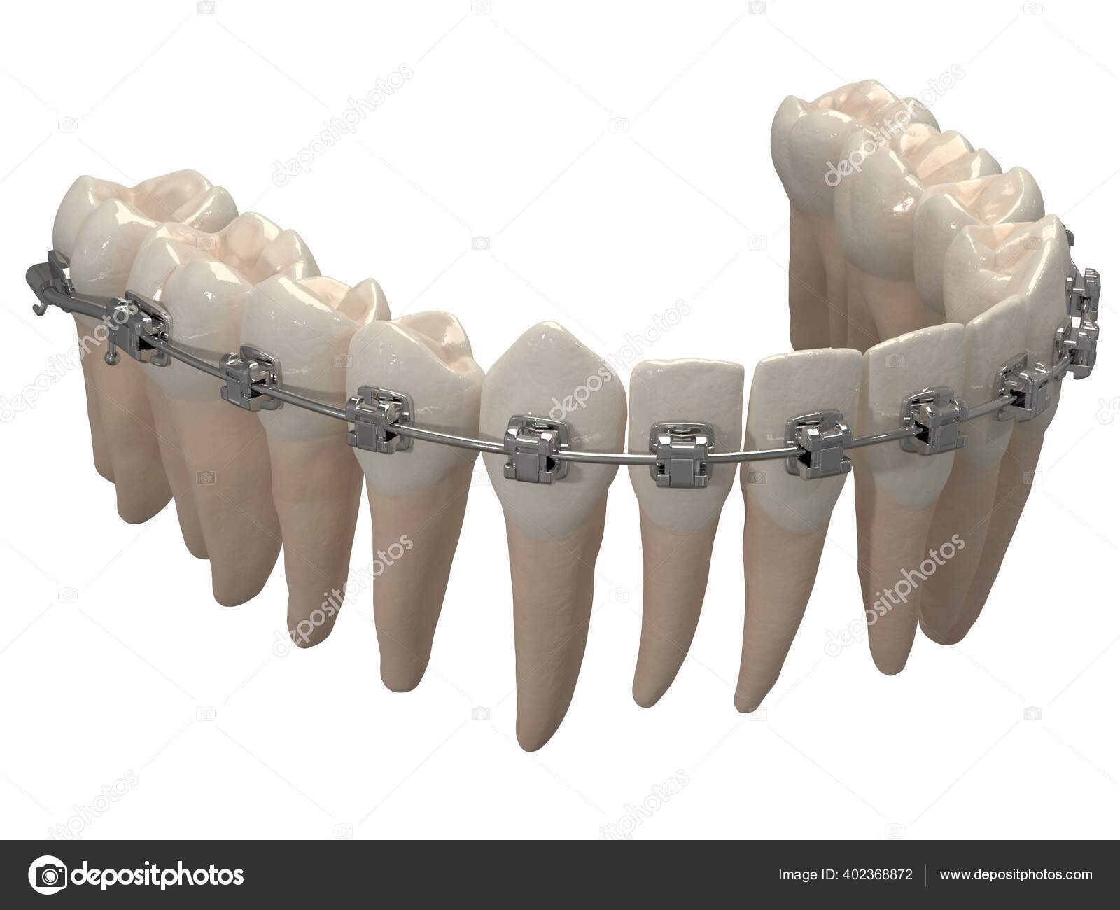 Removable Orthodontic Appliance Used Orthodontic Treatment Retention