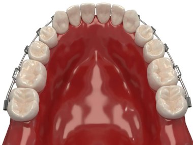 Ortodontik cihazlar, ortodontik tedavi sonrası muhafaza için kullanılır. 3d hazırlayıcı