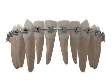 Ortodontik cihazlar, ortodontik tedavi sonrası muhafaza için kullanılır. 3d hazırlayıcı