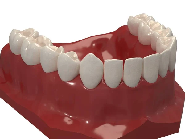 Apparecchio Ortodontico Rimovibile Viene Utilizzato Dopo Trattamento Ortodontico Ritenzione Rendering — Foto Stock