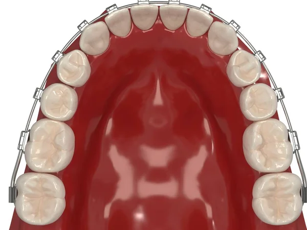 Apparecchio Ortodontico Rimovibile Viene Utilizzato Dopo Trattamento Ortodontico Ritenzione Rendering — Foto Stock