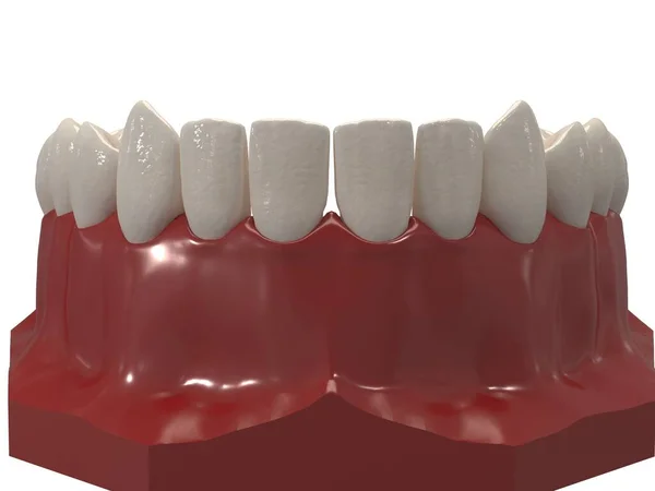 Aparato Ortodoncia Extraíble Utiliza Después Del Tratamiento Ortodoncia Para Retención — Foto de Stock