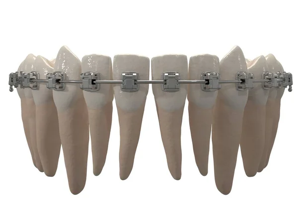 取り外し可能な歯列矯正器具は 保持のための歯列矯正治療後に使用されます 3Dレンダリング — ストック写真