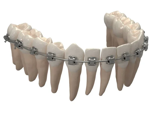 Appareil Orthodontique Amovible Est Utilisé Après Traitement Orthodontique Pour Rétention — Photo