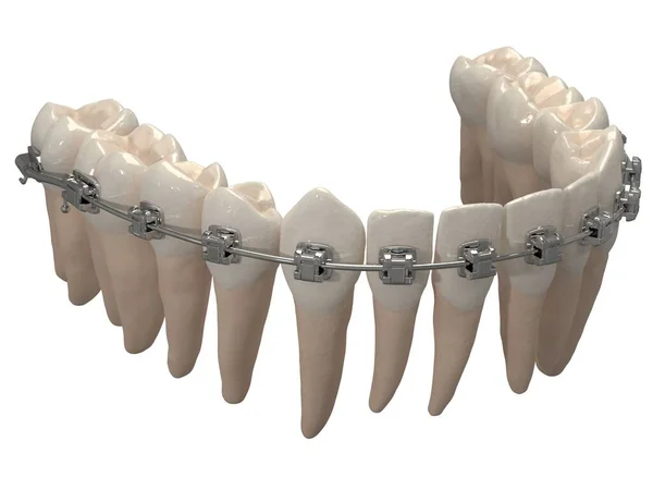 Съемный Ортодонтический Прибор Используется После Ортодонтического Лечения Удержания Рендеринг — стоковое фото