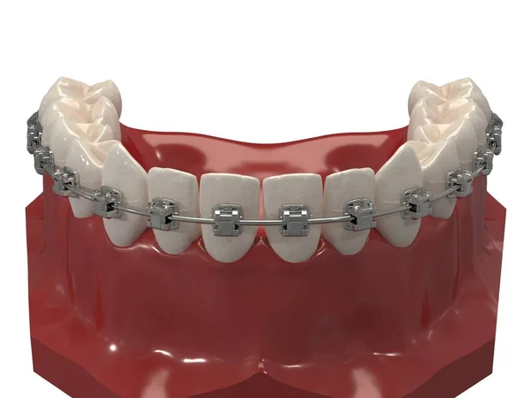 Ortodontik cihazlar, ortodontik tedavi sonrası muhafaza için kullanılır. 3d hazırlayıcı