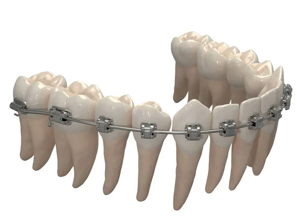 Ortodontik cihazlar, ortodontik tedavi sonrası muhafaza için kullanılır. 3d hazırlayıcı