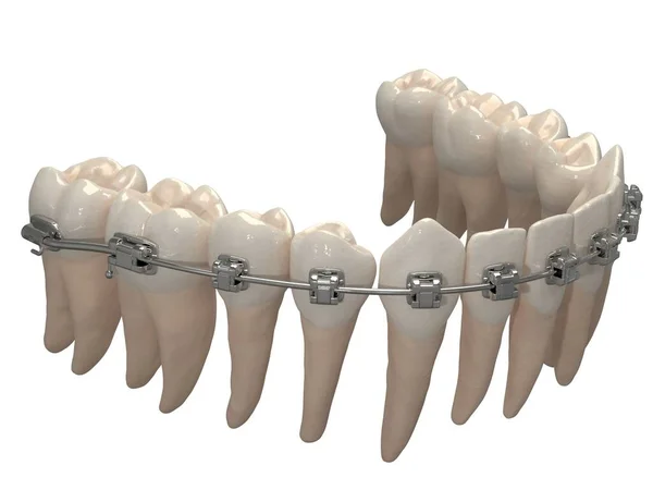 Съемный Ортодонтический Прибор Используется После Ортодонтического Лечения Удержания Рендеринг — стоковое фото