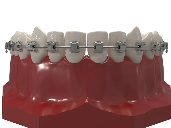 Ortodontik cihazlar, ortodontik tedavi sonrası muhafaza için kullanılır. 3d hazırlayıcı
