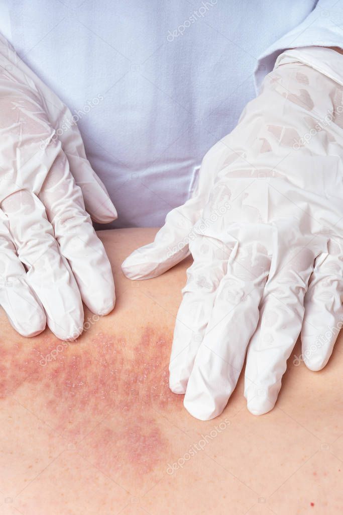 A doctor examines psoriasis on the back of a patient