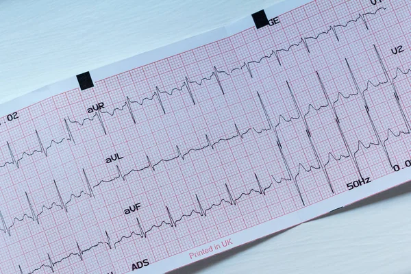 Medical Tests - Paper ECG print out