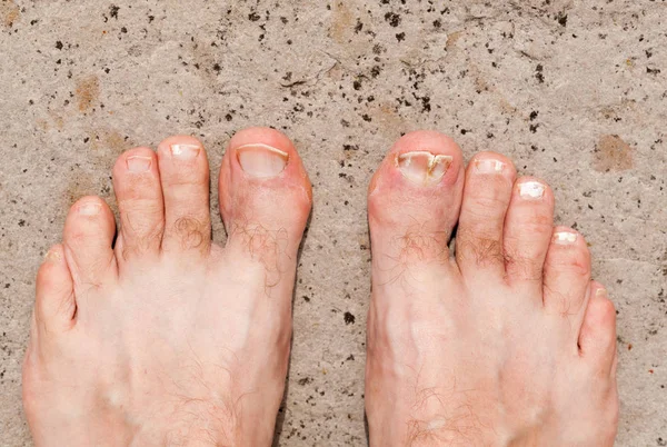 Adult male feet with split toenail and nail fungal infections