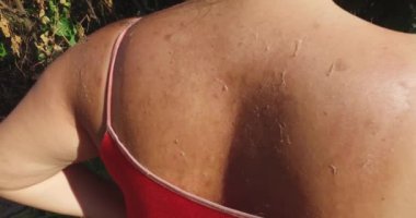 Güneşteki kız, arka planda yeşille, teninde güneş yanığı olan, benlerinde kırmızı olan..