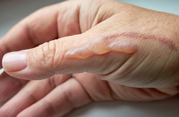 Brandwonden Hand Van Een Vrouw Letsel Handen — Stockfoto