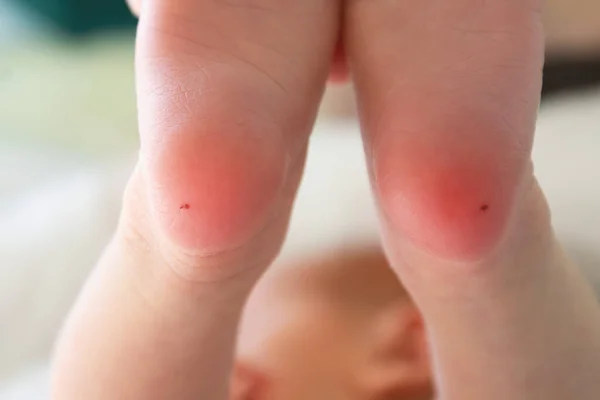 Yeni doğmuş topuk iğnesi testi ve lolipop ponksiyonu.. — Stok fotoğraf