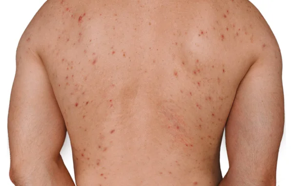 Acne adolescenziale. Giovane ragazzo con la pelle problema sulla schiena larga: macchie rosse e brufoli. Concetto: allergie ed eruzioni cutanee da farmaci, cibo grasso spazzatura — Foto Stock