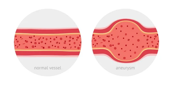 Gezonde Zieke Met Aneurysma Met Bloedcellen Platte Vectorillustratie — Stockvector