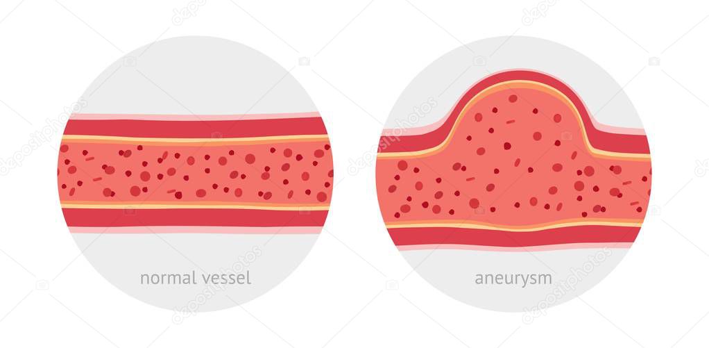 Healthy vessel and sick vessel with aneurysm with blood cells flat vector illustration