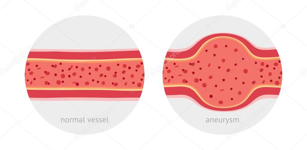 Healthy vessel and sick vessel with aneurysm with blood cells flat vector illustration