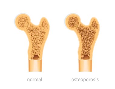 Vektör çizim insan kemik, sağlıklı ve osteoporoz ile