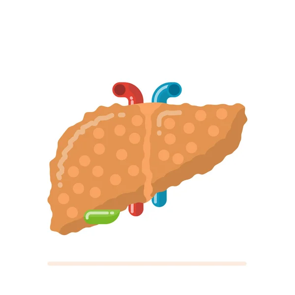 病态受损脂肪肝合并肝硬化的扁平化设计例证 — 图库矢量图片
