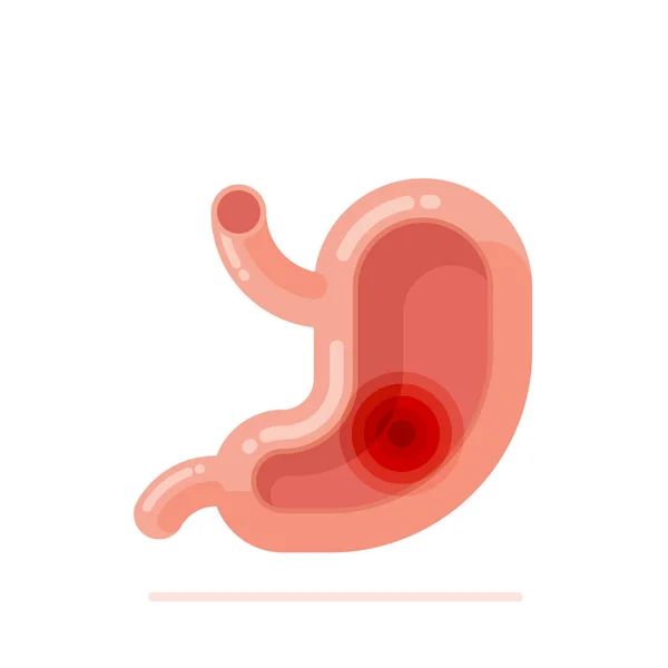 Diseño Plano Vector Ilustración Del Estómago Humano Con Concepto Úlcera — Vector de stock