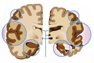 Bu örnekte iki yarısı beyin, sağlıklı bir buçuk ve başka bir Alzheimer ile bu gördüğümüz serebral korteks sözleşmeler, beyin hasar nedenleri, eskiden bu beyin azaltma planı ve hatırladığın karşılaştırmasını gösterir