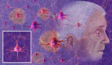 Alzheimer hastalığı unutkanlık ve kayıp düşünceler. Bu örnekte, yaşlı bir adam ve onun arkasında Alzheimer hastalığı neden nöronların ölümüyle gösterir.