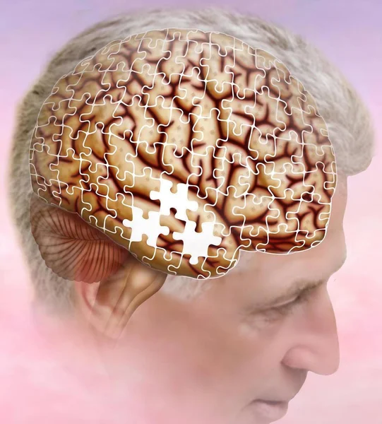 Alzheimer Disease Forgetfulnessalzheimer Lost Thoughts Illustration Shows Brain Were Puzzle — Stock Photo, Image