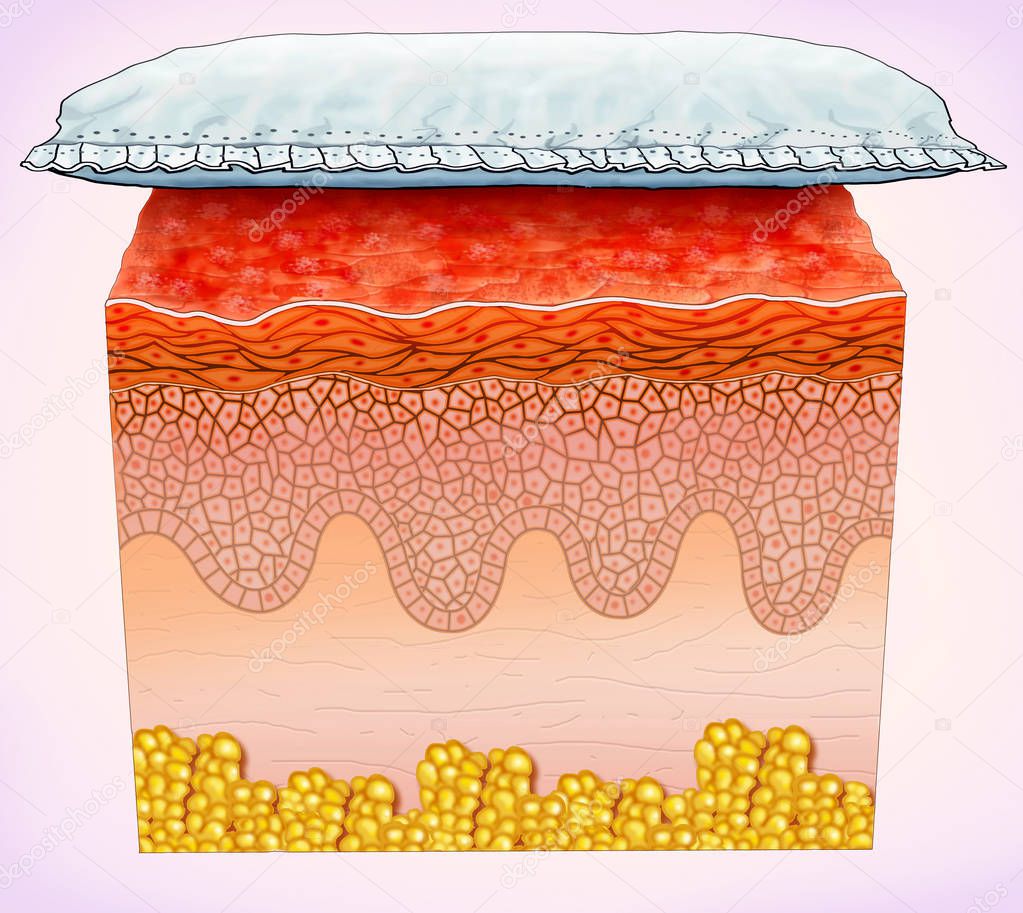 Schematic illustration of a segment of skin affected by diaper rash,It is a skin disease with possible irritation of the dermis / epidermis in areas with more direct contact with the diaper as external genital organs