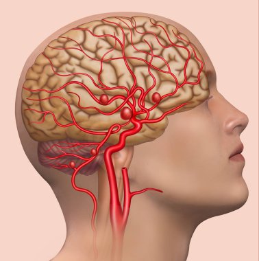 Human head, rendered, on a blue background, with an aneurysm in the internal carotid artery. clipart