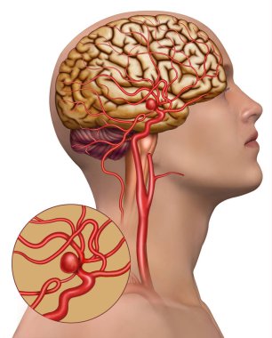 Descriptive illustration of a cerebral artery affected by a cerebral aneurysm. clipart