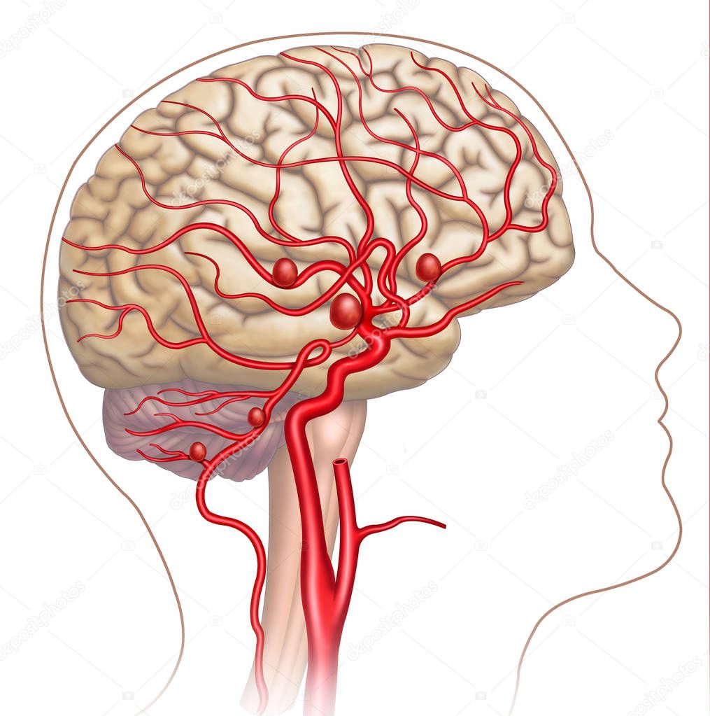 Schematic illustration composed by human head in which we can see the brain and the main arteries, in the podemo see the development of cerebral aneurysms.