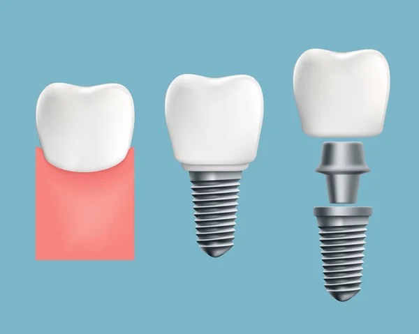 Şematik Infographics Insan Diş Diş Implantı Hisse Senedi Vektör Çizim — Stok Vektör