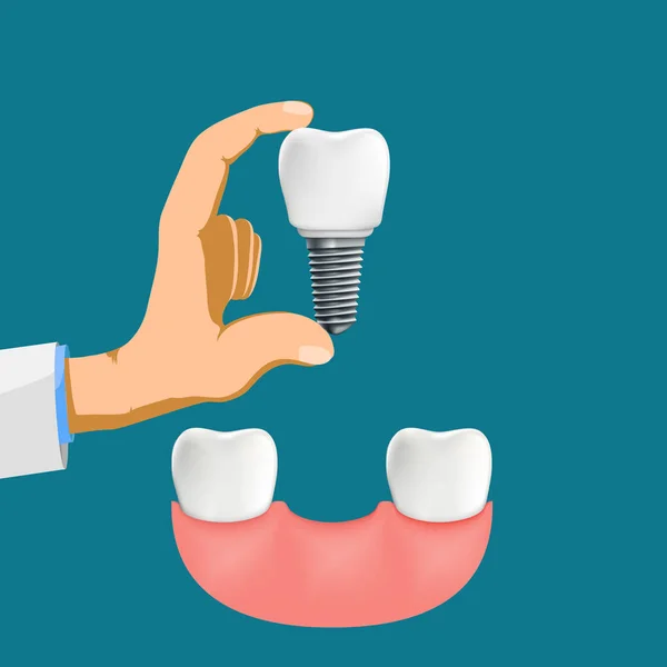 Fogorvos Fogászati Implantátum Tart Kezében Vektor Stock Illusztráció — Stock Vector